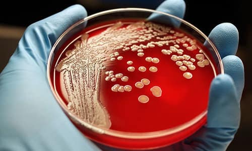 superbug