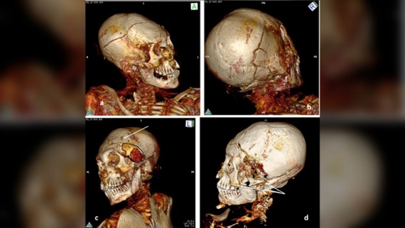 'Massive trauma' found on 1,000-year-old South American mummies