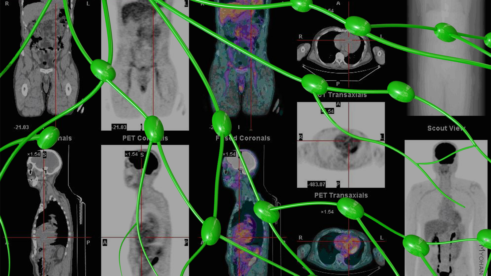 A computer rendering of lymph nodes over a whole body PET/CT scan