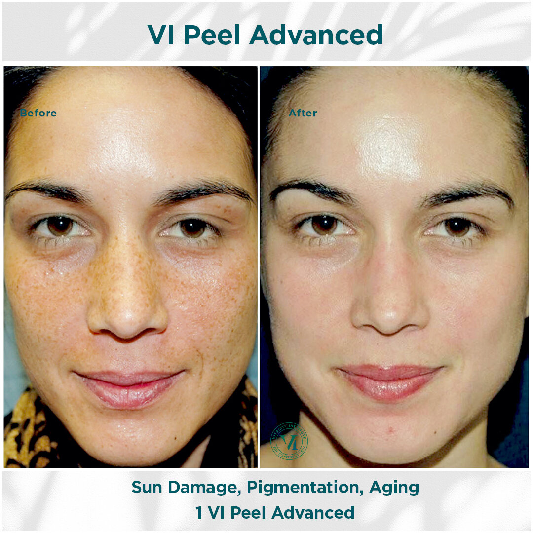 VI peel before and after