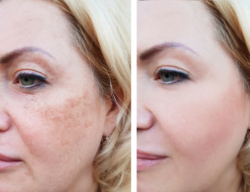 girl face wrinkles before and after_ pigmentation