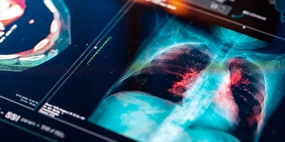 8. Un algoritmo de aprendizaje profundo para agilizar el tratamiento de radioterapia del cáncer de pulmón