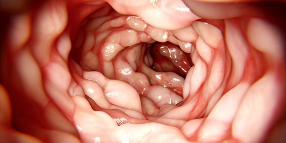 7. La relación entre el norovirus y la enfermedad de Crohn podría apuntar a nuevas terapias