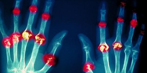 2. ¿Pueden las bacterias intestinales causar artritis reumatoide?