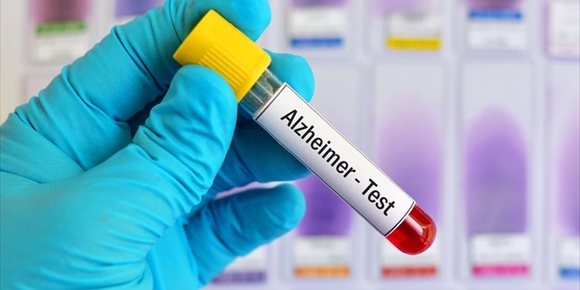 6. Una nueva prueba detecta en sangre la neurodegeneración del Alzheimer
