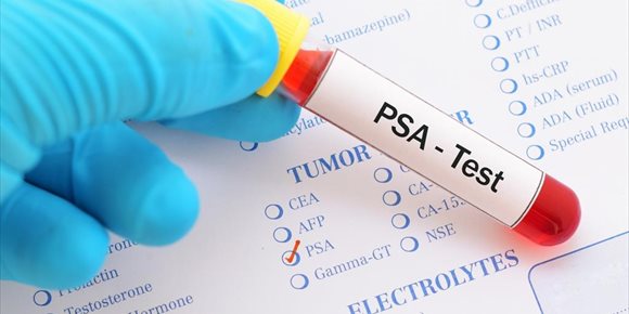 6. Los niveles de PSA tras el tratamiento pueden no ser un indicador fiable de la supervivencia en cáncer de próstata