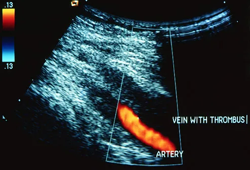dvt ultrasound