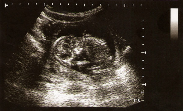 Ultrasound image of preborn baby