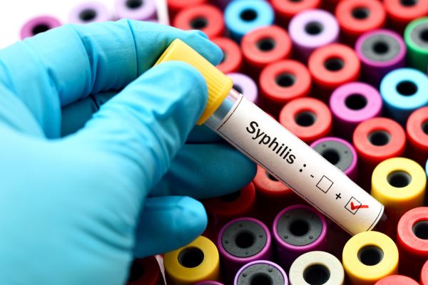A test tube with a positive syphilis result. 
