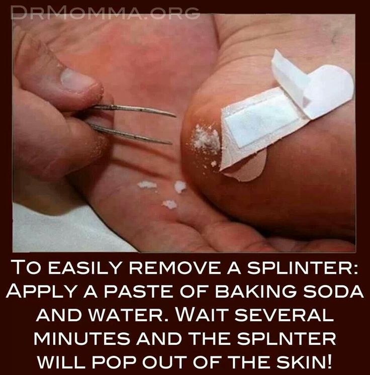 Image result for how to extract a splinter