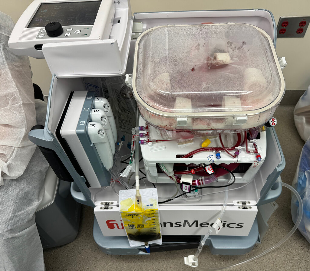 A transparent box-like container with a human liver inside, its top closed and a number of tubes and other machinery attached.