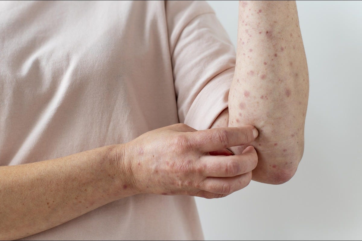 Measles: Symptoms, Treatment & Prevention Measles: Symptoms, Treatment & Prevention