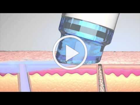 How does HydraFacial MD treatment work?