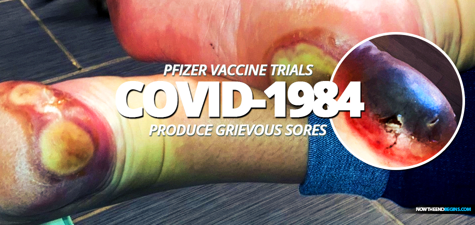 patricia-chandler-pfizer-bionmed-covid-1984-coronavirus-vaccine-trials-produces-grievous-sores-on-feet-fixed-drug-eruption-revelation-16