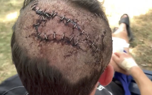 Heim had to get 34 stitches and has a minor skull fracture