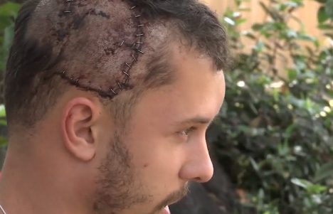 The personal trainer escaped the attack without brain damage